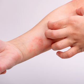 Eczema Flare-Ups (And How to Soothe Them Naturally)